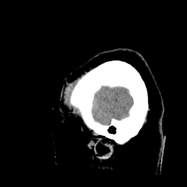 File:Chiasmatic-hypothalamic juvenile pilocytic astrocytoma (Radiopaedia 78533-91237 B 10).jpg