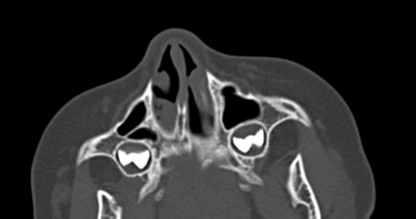 Choanal atresia (Radiopaedia 51295-56972 Axial bone window 11).jpg