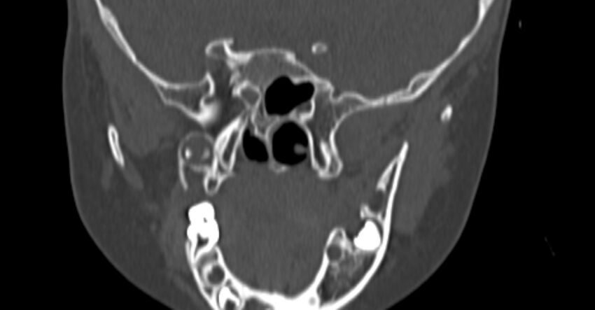 Choanal atresia (Radiopaedia 51295-56972 Coronal bone window 78).jpg