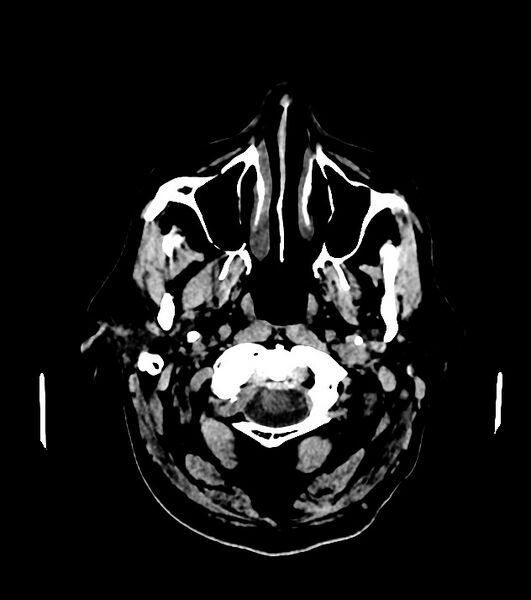 File:Cholangiocarcinoma with cerebral metastases (Radiopaedia 83519-98628 Axial non-contrast 8).jpg