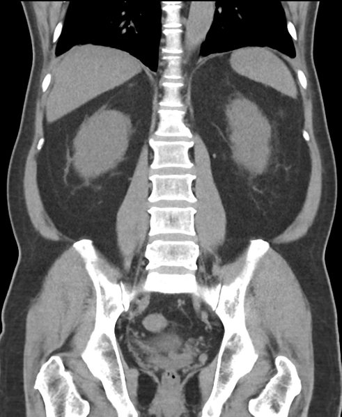 File:Cholecystitis with focal perforation and hepatic abscess (Radiopaedia 37189-38945 Coronal non-contrast 40).png