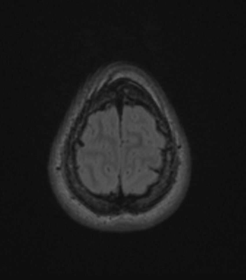 Choroid plexus carcinoma (Radiopaedia 91013-108553 Axial FLAIR C+ 192).jpg