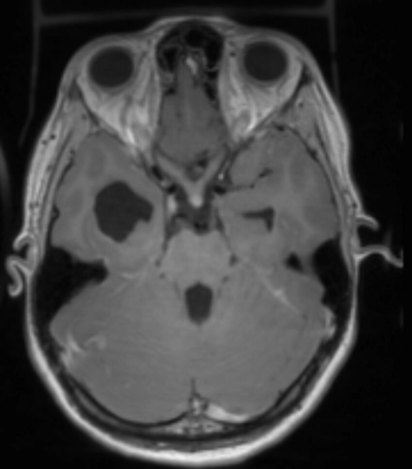Choroid plexus carcinoma (Radiopaedia 91013-108553 Axial T1 C+ 108).jpg