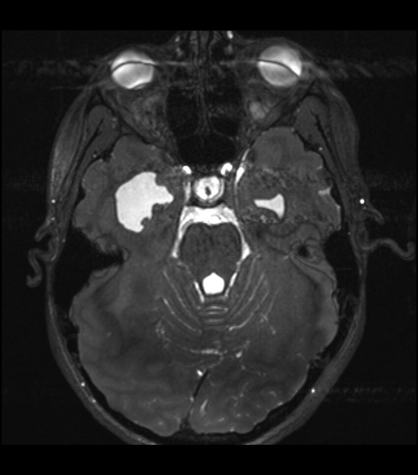 Choroid plexus carcinoma (Radiopaedia 91013-108553 Axial T2 CISS 6).jpg