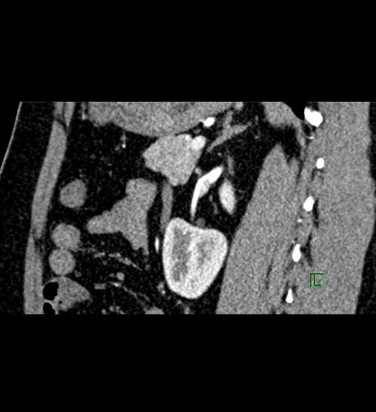 File:Chromophobe renal cell carcinoma (Radiopaedia 84286-99573 F 61).jpg