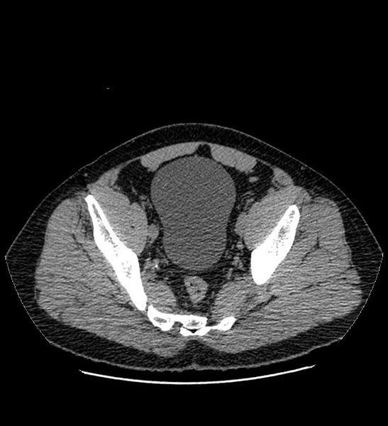 File:Chromophobe renal cell carcinoma (Radiopaedia 84337-99693 Axial non-contrast 135).jpg