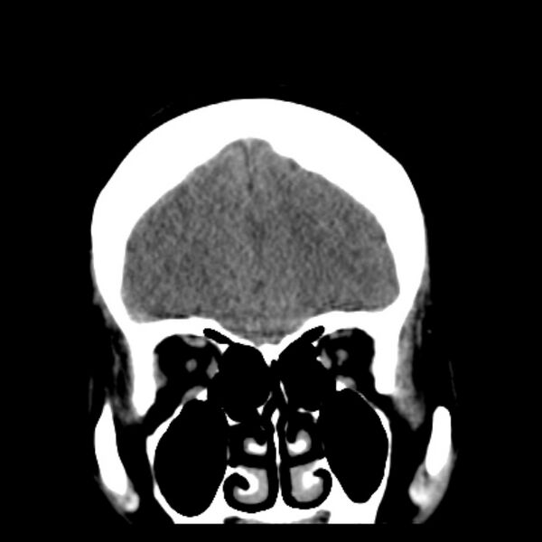 File:Chronic bilateral occipital lobe infarcts (Radiopaedia 31276-31996 Coronal non-contrast 13).jpg