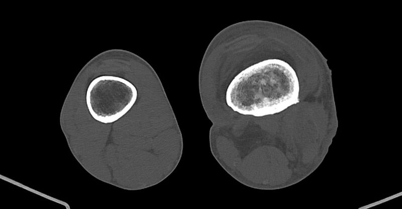 File:Chronic osteomyelitis (with sequestrum) (Radiopaedia 74813-85822 Axial non-contrast 161).jpg