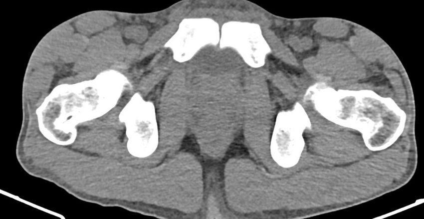 Chronic osteomyelitis (with sequestrum) (Radiopaedia 74813-85822 D 44).jpg