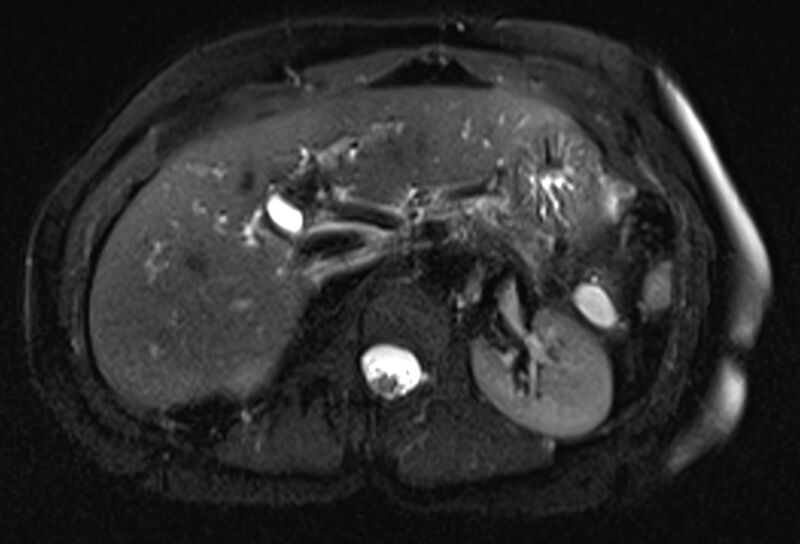 File:Chronic pancreatitis - pancreatic duct calculi (Radiopaedia 71818-82250 Axial T2 fat sat 22).jpg