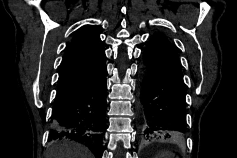 File:Chronic pulmonary embolism with bubbly consolidation (Radiopaedia 91248-108850 B 119).jpg