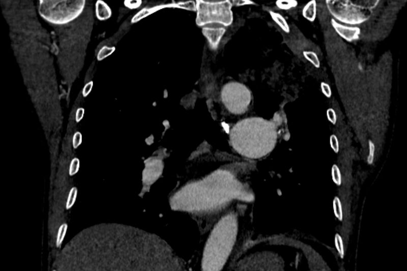 File:Chronic pulmonary embolism with bubbly consolidation (Radiopaedia 91248-108850 B 85).jpg
