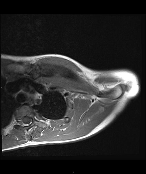 File:Chronic reactive multifocal osteomyelitis (CRMO) - clavicle (Radiopaedia 56406-63071 Axial T1 10).jpg