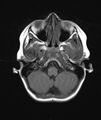 Chronic reactive multifocal osteomyelitis (CRMO) - mandible (Radiopaedia 56405-63069 Axial T1 21).jpg