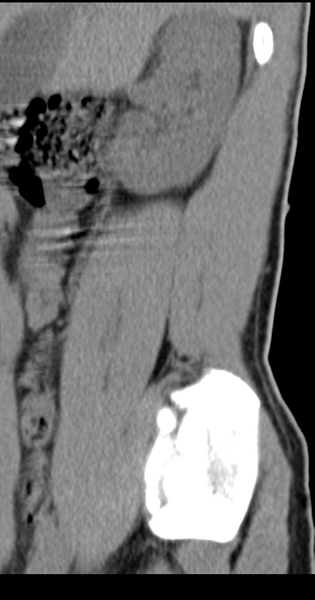 File:Clear cell meningoma - lumbar spine (Radiopaedia 60116-67691 A 42).png