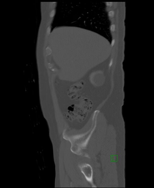 File:Clear cell renal cell carcinoma (Radiopaedia 85006-100539 Sagittal bone window 51).jpg