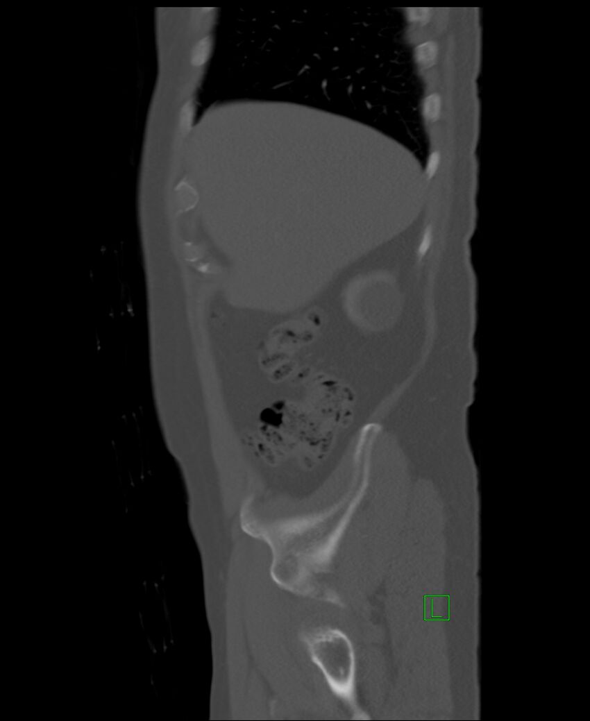 Clear cell renal cell carcinoma (Radiopaedia 85006-100539 Sagittal bone window 51).jpg