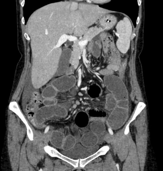 File:Closed loop small bowel obstruction (Radiopaedia 71211-81508 B 39).jpg