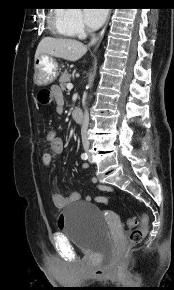 File:Closed loop small bowel obstruction - adhesions (Radiopaedia 59269-66611 C 57).jpg
