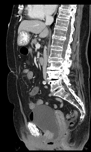 File:Closed loop small bowel obstruction - adhesions (Radiopaedia 59269-66611 C 59).jpg