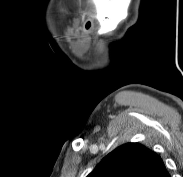 File:Colloid cyst of thyroid (Radiopaedia 22897-22923 Sagittal C+ delayed 54).jpg