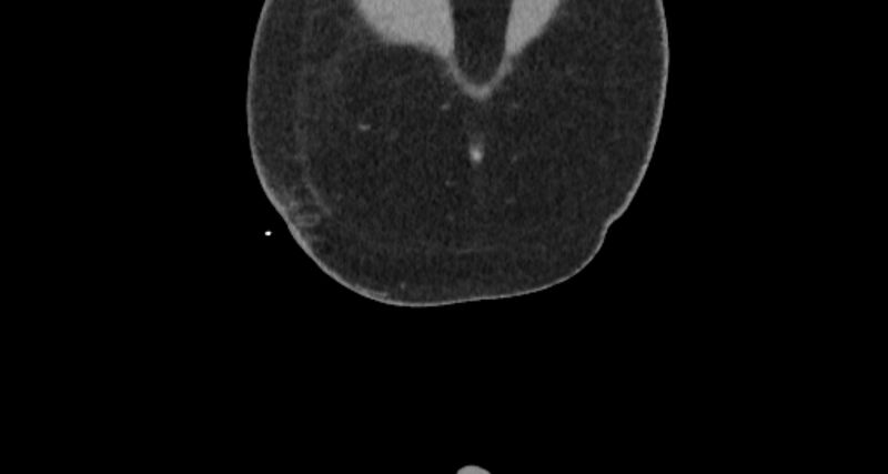 File:Colocutaneous fistula (Radiopaedia 56401-63062 C 2).jpg