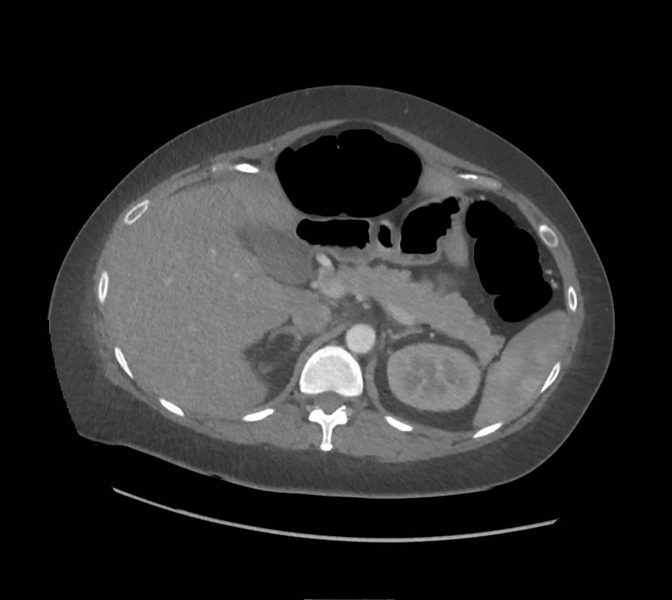 File:Colonic pseudo-obstruction (Radiopaedia 79752-92980 A 54).png