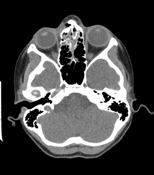 File:Nasoorbitoethmoid fracture (Radiopaedia 90044-107205 Axial non-contrast 154).jpg