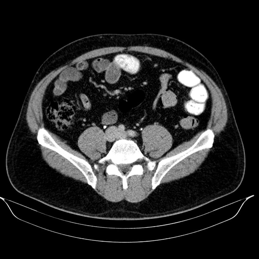 Neuroendocrine tumor of head of pancreas (Radiopaedia 57538-64502 D 57).jpg