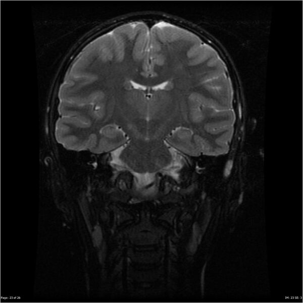 File:Neurofibromatosis type 1 (Radiopaedia 22541-22564 C 23).jpg