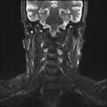 Neurofibromatosis type 1 (Radiopaedia 80355-93740 Coronal STIR 5).jpg