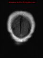 Neuroglial cyst (Radiopaedia 10713-11184 Coronal FLAIR 2).jpg