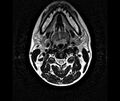 Nitrous oxide induced myeloneuropathy (Radiopaedia 30557-31222 Axial T2 1).jpg