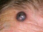 Nodular melanoma (DermNet NZ nm4).jpg
