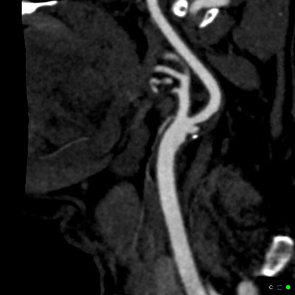 File:Non-occlusive intraluminal internal carotid artery thrombus (Radiopaedia 37751-39658 C 59).jpg