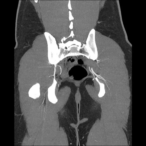 File:Normal CT angiogram of pelvis (Radiopaedia 45390-49430 B 36).jpg