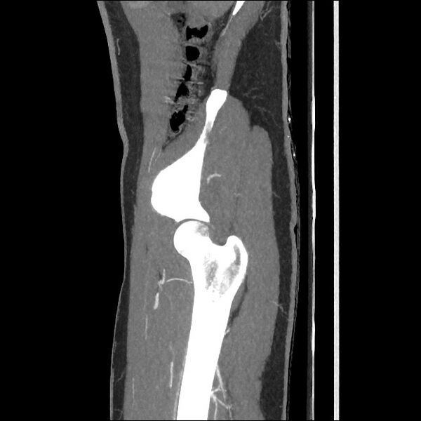 File:Normal CT angiogram of pelvis (Radiopaedia 45390-49430 C 15).jpg