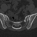 Normal CT lumbar spine (Radiopaedia 53981-60118 Axial bone window 76).jpg