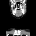 Normal CT of the neck (Radiopaedia 14575-14500 Coronal C+ 17).jpg