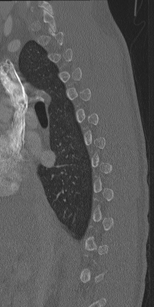 File:Normal CT thoracic spine (Radiopaedia 40181-42688 Sagittal bone window 48).png