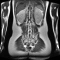 Normal MRI abdomen in pregnancy (Radiopaedia 88001-104541 Coronal T2 26).jpg