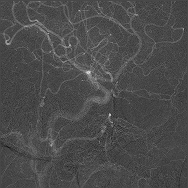 File:Normal cerebral angiogram (four vessel DSA) (Radiopaedia 41708-44649 I 10).png