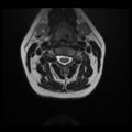 Normal cervical and thoracic spine MRI (Radiopaedia 35630-37156 Axial T2 22).png