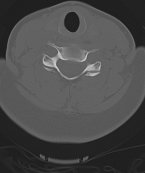 File:Normal cervical spine MRI (including Dixon) (Radiopaedia 42762-45926 Axial bone window 37).png