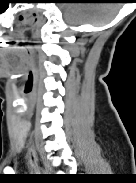 File:Normal cervical spine MRI (including Dixon) (Radiopaedia 42762-45926 C 22).png
