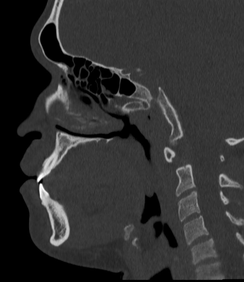 Normal facial bone CT (Radiopaedia 88742-105476 Sagittal bone window 96).jpg