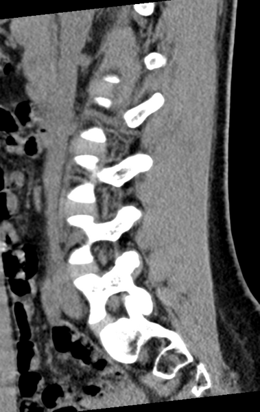 File:Normal lumbar spine CT (Radiopaedia 46533-50986 C 66).png