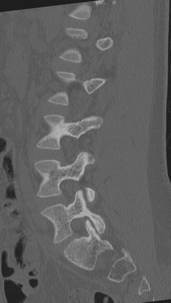 File:Normal lumbar spine CT (Radiopaedia 46533-50986 Sagittal bone window 38).png