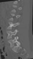 Normal lumbar spine CT (Radiopaedia 46533-50986 Sagittal bone window 38).png