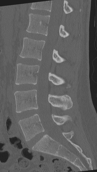 File:Normal lumbar spine CT (Radiopaedia 46533-50986 Sagittal bone window 50).png